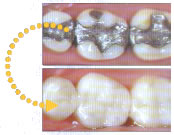 white fillings